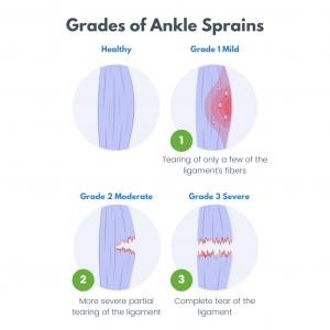 Ankle sprain ligament grades of injury